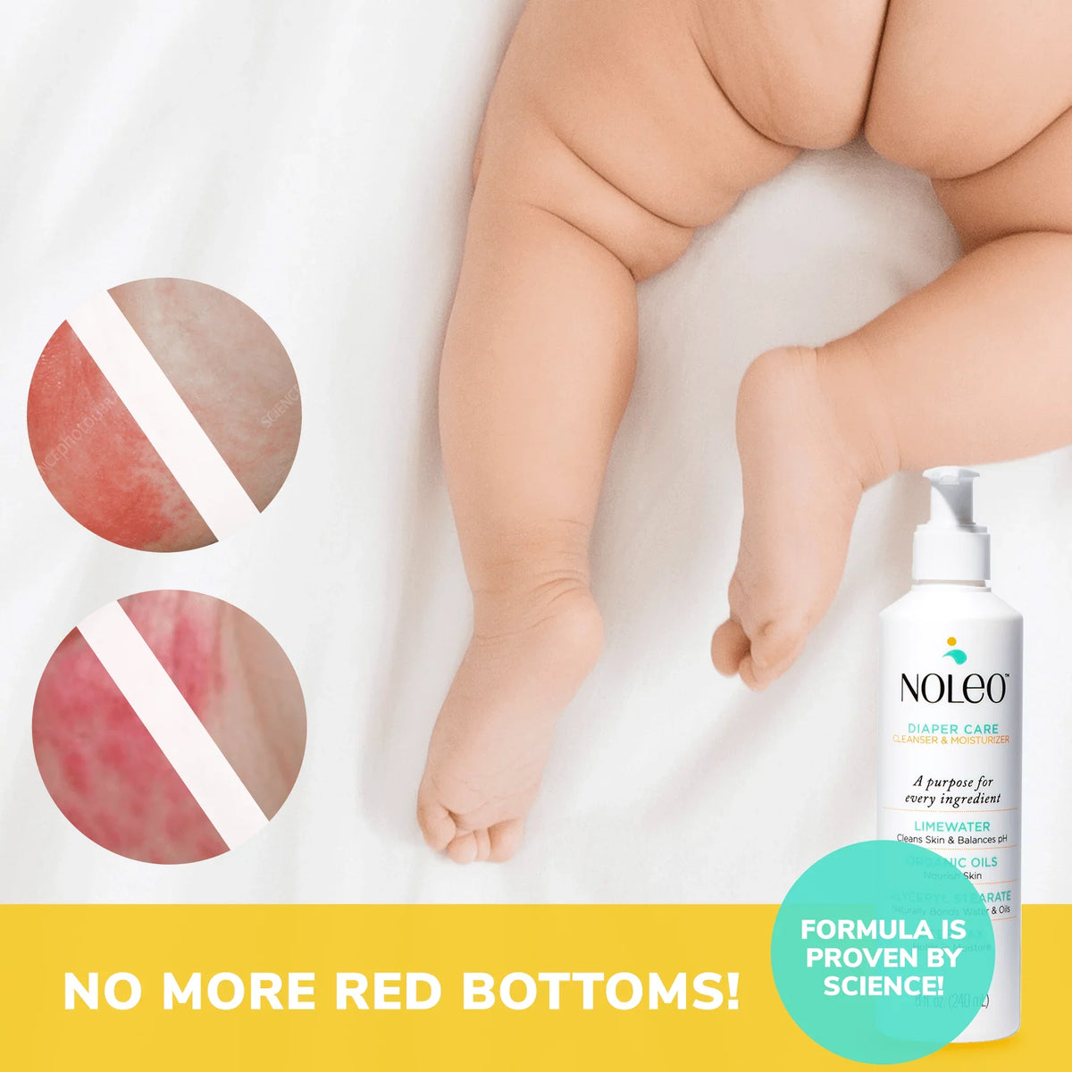 Treatment Diaper Rash Rash for NOLEO DUO Butt -